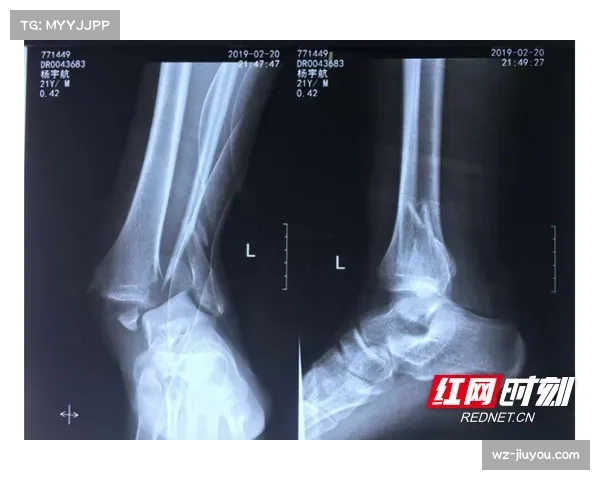 科利尔初步评估结果显示左脚踝无骨折伤情 万幸避免重伤 科利尔初步评估结果显示左脚踝无骨折伤情 万幸避免重伤